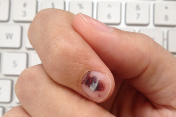 Bruised Fingernail